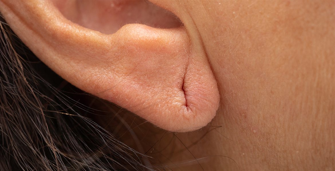 EAR LOBE REPAIR